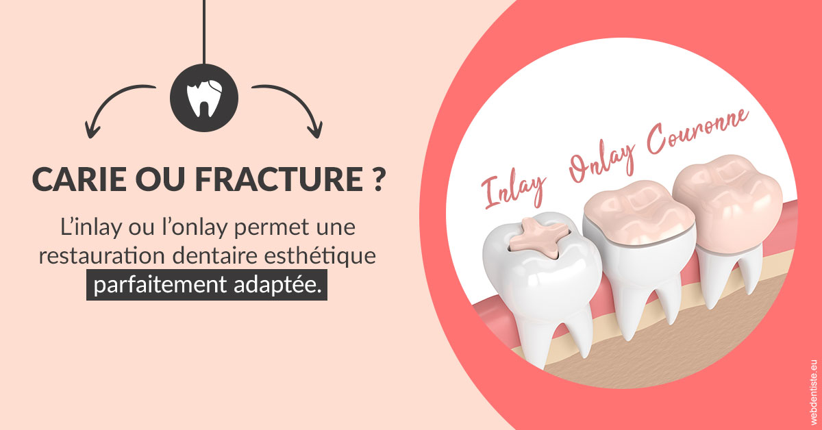 https://dr-le-gall-nicolas.chirurgiens-dentistes.fr/T2 2023 - Carie ou fracture 2