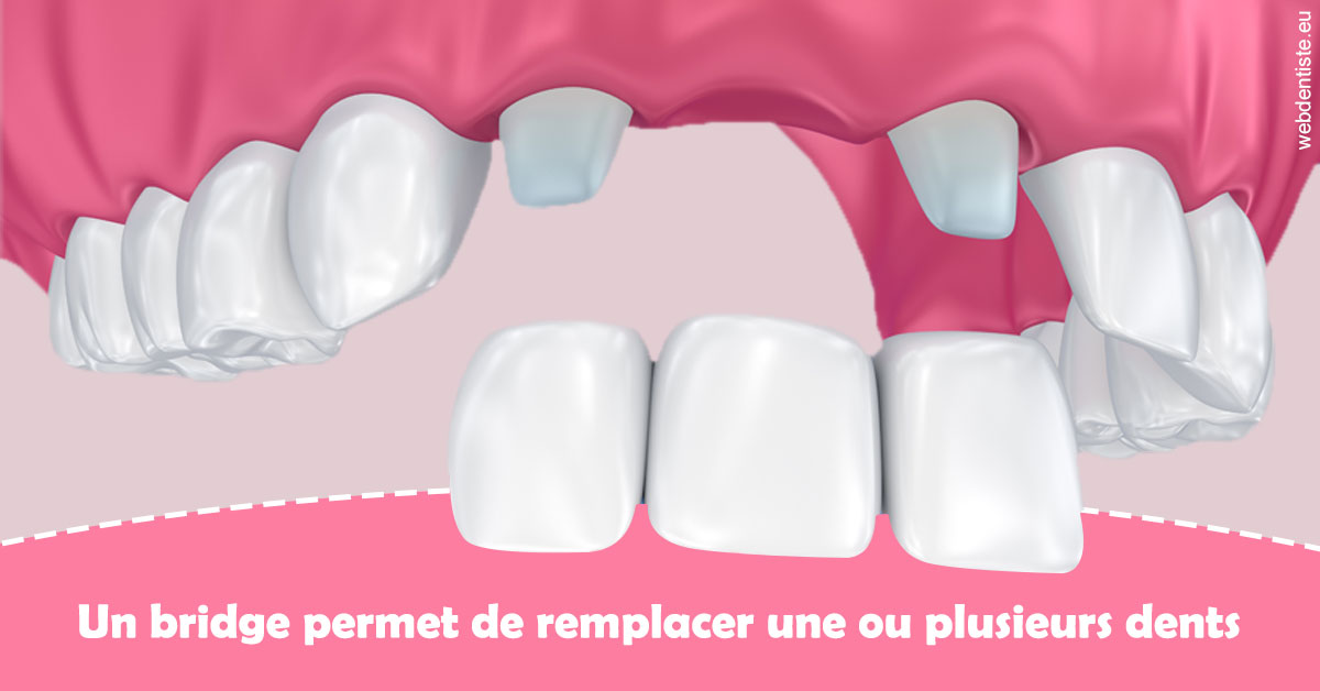 https://dr-le-gall-nicolas.chirurgiens-dentistes.fr/Bridge remplacer dents 2