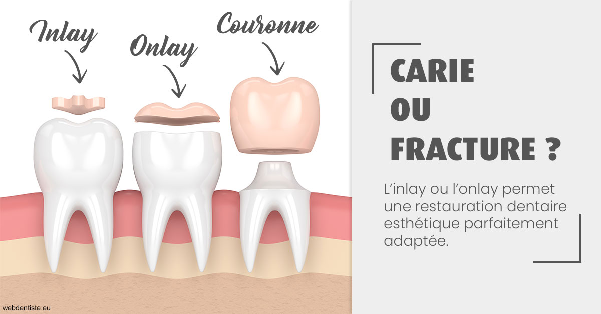 https://dr-le-gall-nicolas.chirurgiens-dentistes.fr/T2 2023 - Carie ou fracture 1