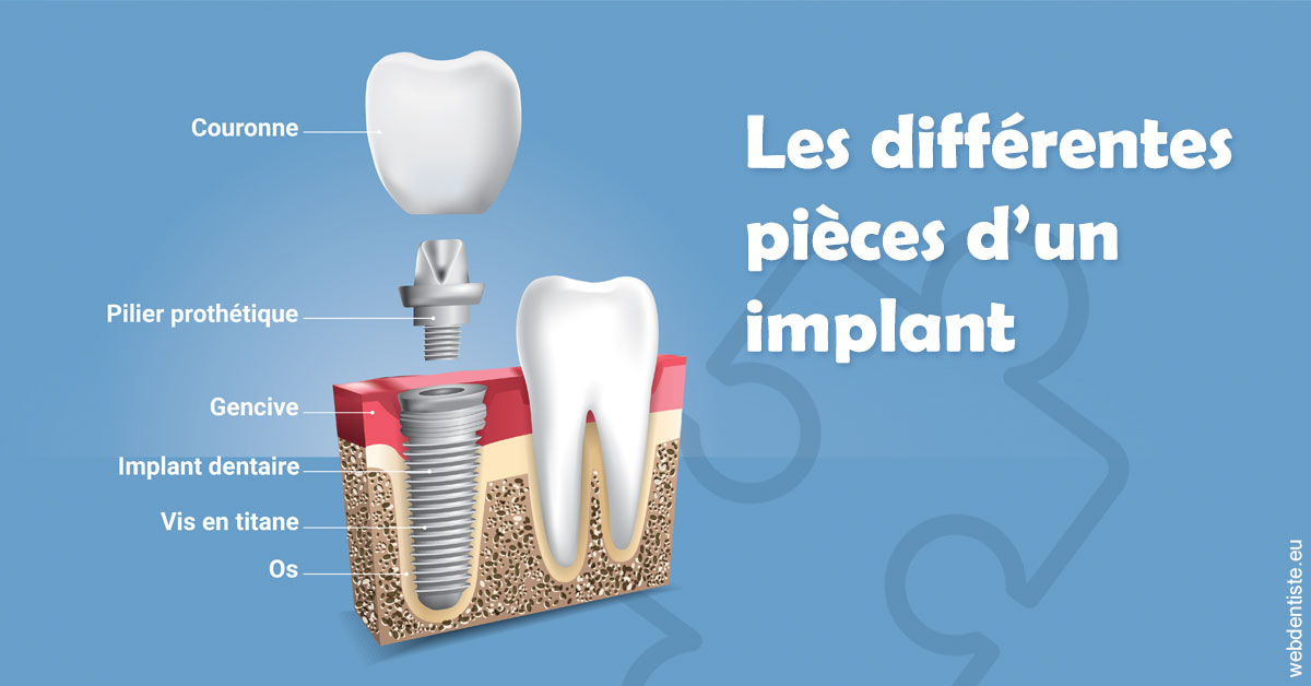 https://dr-le-gall-nicolas.chirurgiens-dentistes.fr/Les différentes pièces d’un implant 1